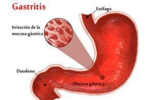 gastritis